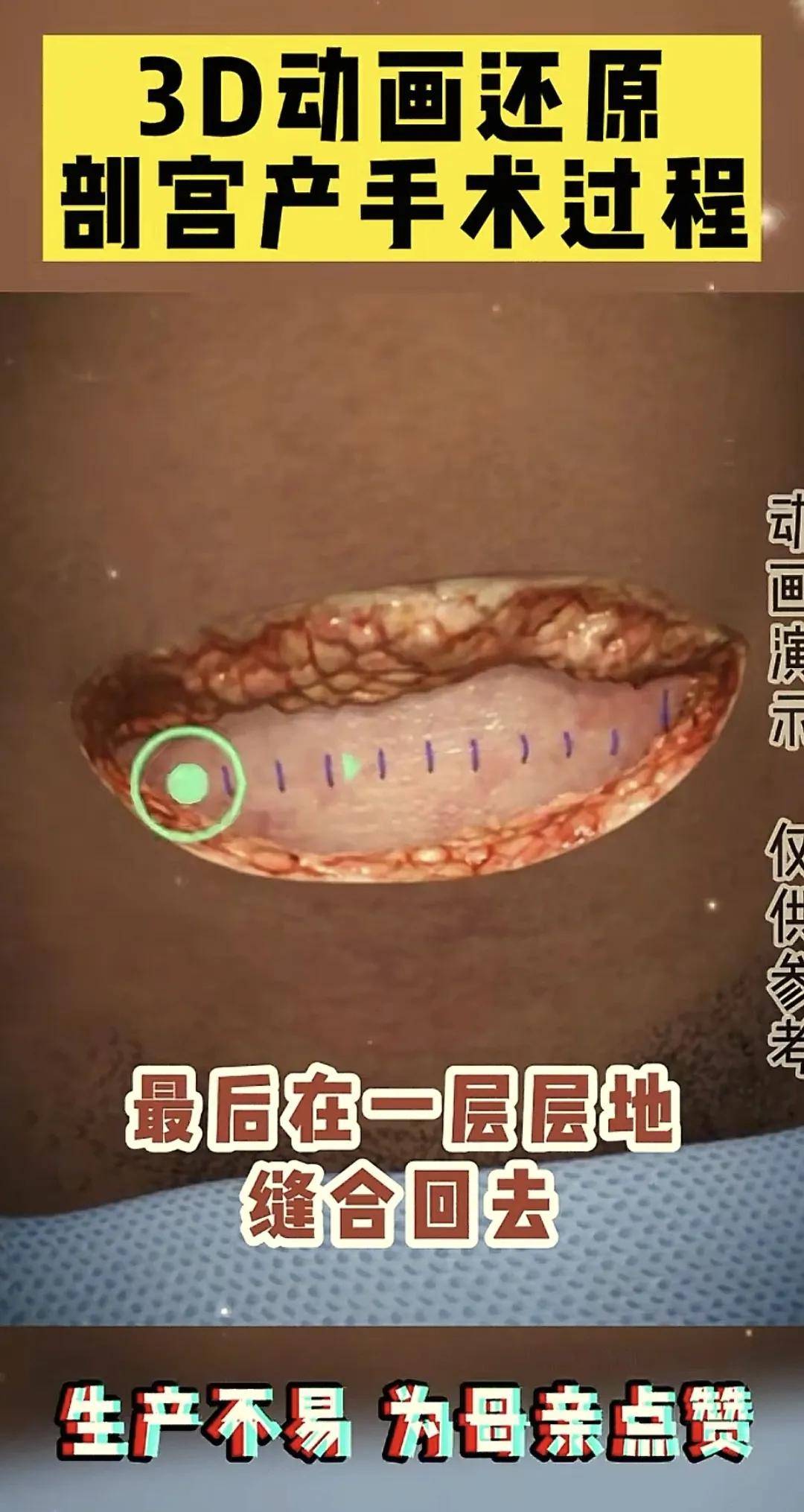 组图告诉你剖腹产有多痛？3d动画还原剖宫产手术过程