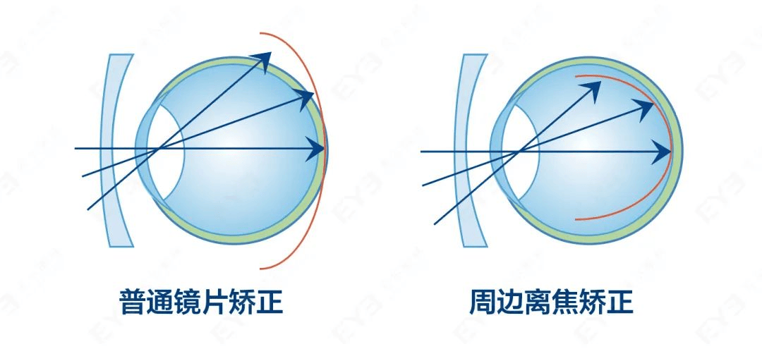 湖北爱尔眼科医院离焦镜 湖北爱尔眼科医院离焦镜