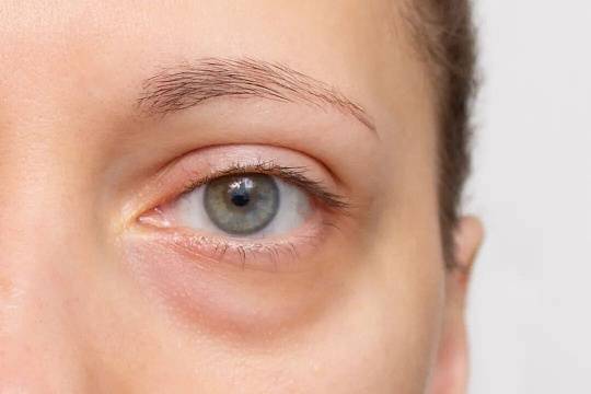眼袋还分真假？乌鲁木齐曾学文主任：别乱折腾，越弄越糟