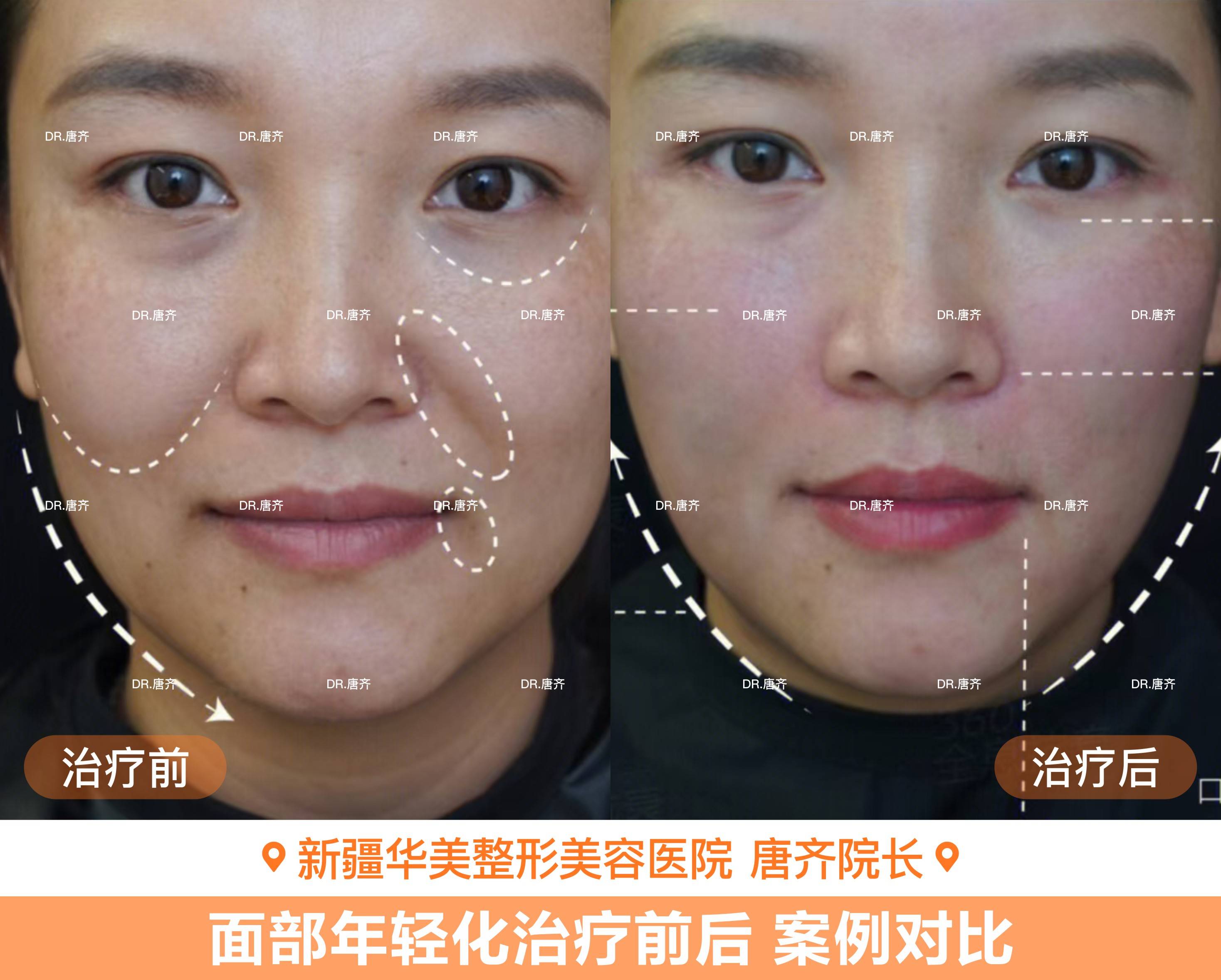 乌鲁木齐华美口周抗衰如何选择合适的医生