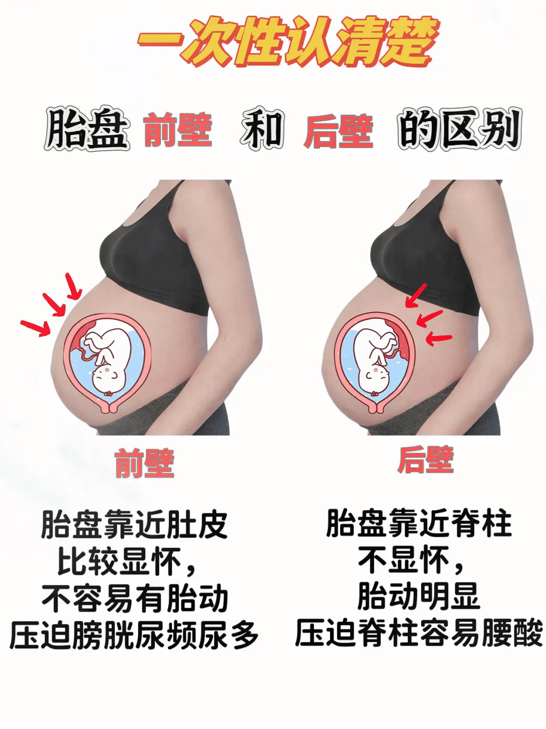 胎盘前壁和后壁的区别，你真的了解吗？