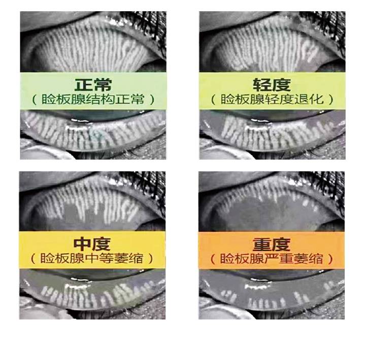 从ICC大会到中山爱尔眼科:十周年落地热脉动技术,精准诊疗年轻人反复干眼(图2) 从ICC大会到中山爱尔眼科:十周年落地热脉动技术,精准诊疗年轻人反复干眼(图2)
