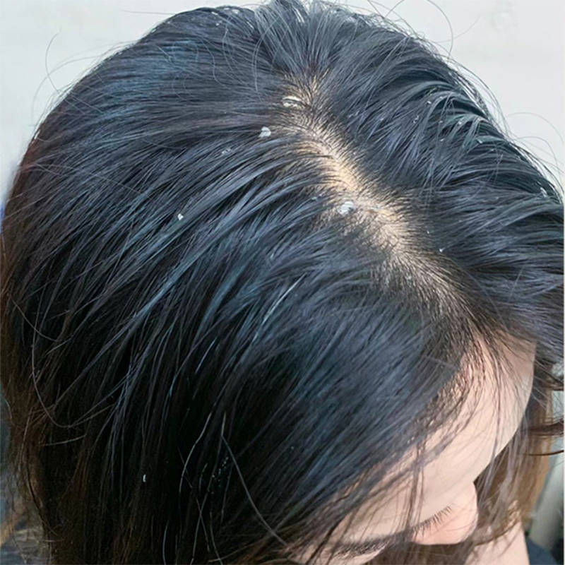 哪种洗发水去屑?舒缓去屑洗发水推荐