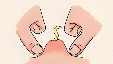 痘痘挤出来的分泌物是什么？