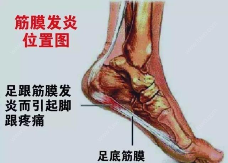 得了足底筋膜炎这样根治!这些方法教你自救,强烈建议收藏!