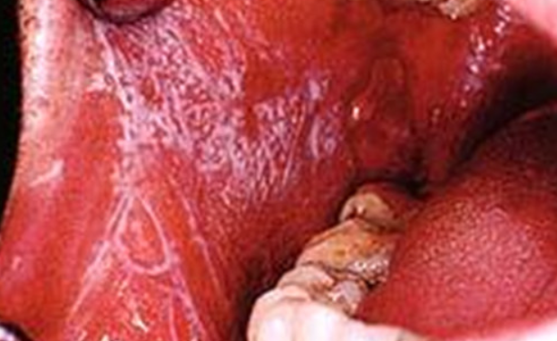 口腔扁平苔藓与口腔溃疡有什么区别_黏膜_患者_症状