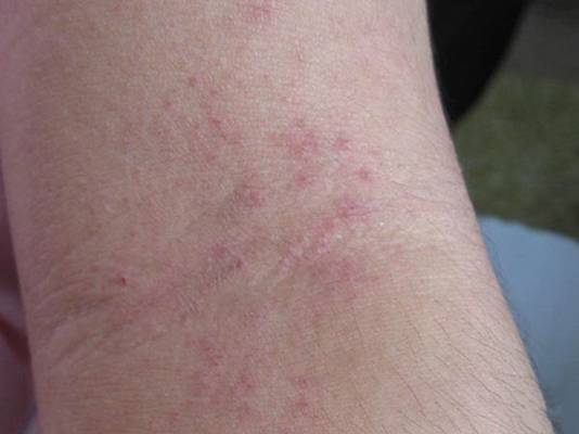 急性湿疹是指早期湿疹发作,它的症状为皮肤自觉瘙痒