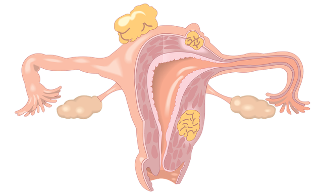 肿瘤科于加军:子宫肌瘤会有哪些症状?如何预防?