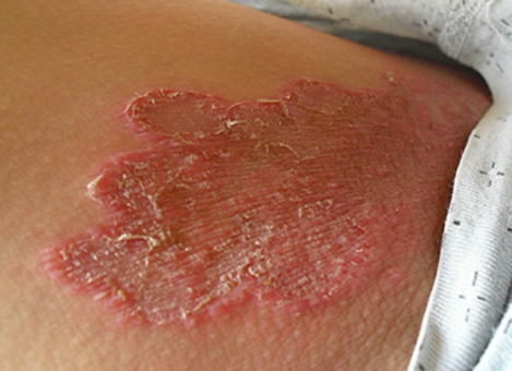 阴囊湿疹初期症状图片图片