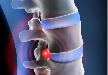 什么是多发性末梢神经炎?_治疗_疾病_病因