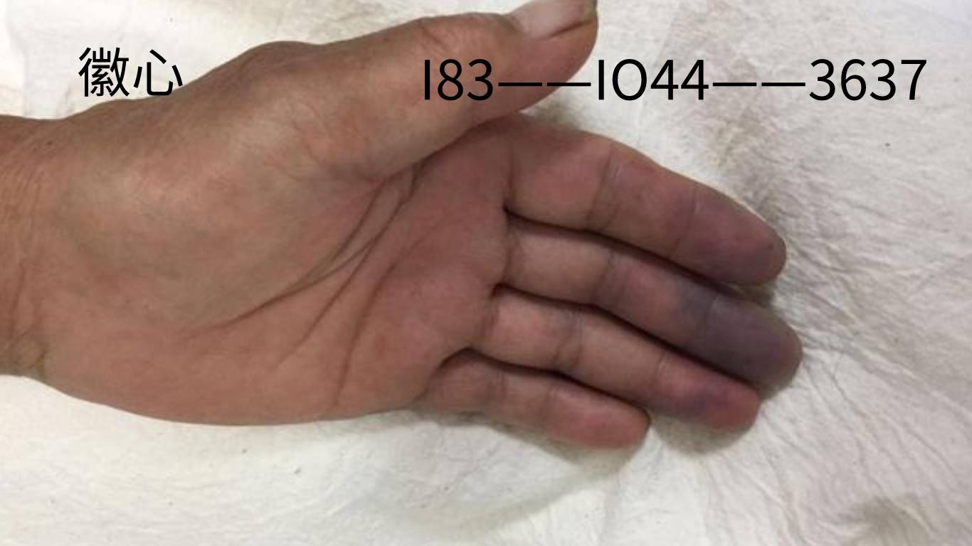 症状1 :雷诺氏现象严重.手遇冷时会发黑发紫症状2 :皮肤硬.