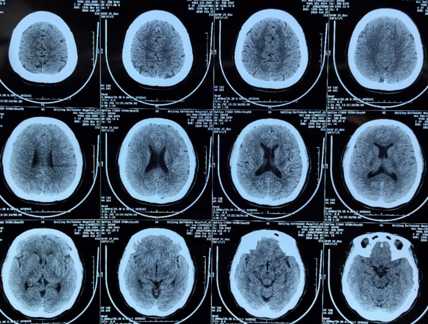 李小勇脑脊液专业对首次和多次脑脊液鼻漏修补术失败者的优势_策略_病