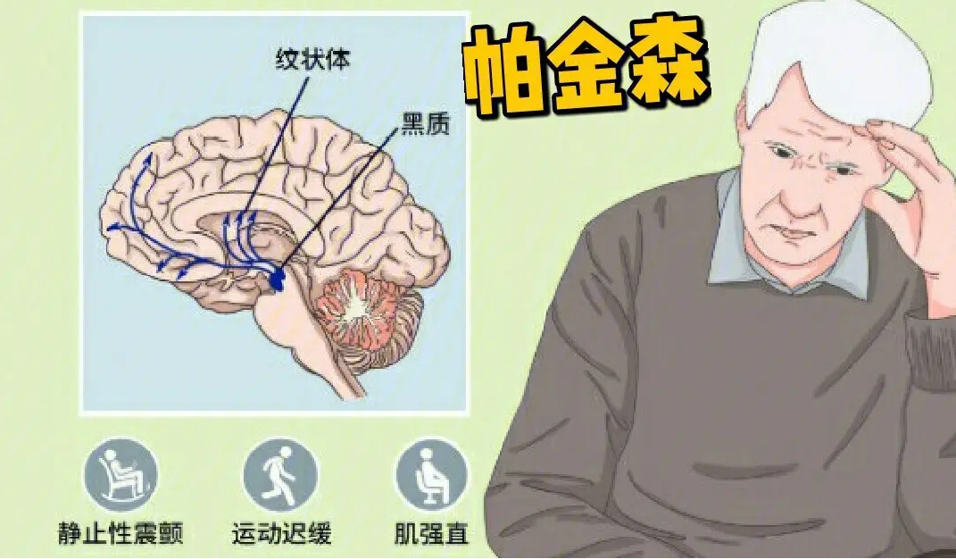 手不抖但走路慢,是帕金森病吗?_症状_患者_古方