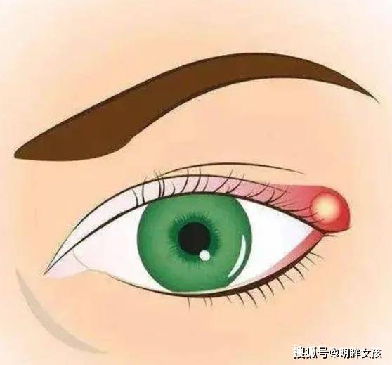 睑板腺囊肿发生原因,治疗方式和预防措施详解_眼睑_油脂_进行