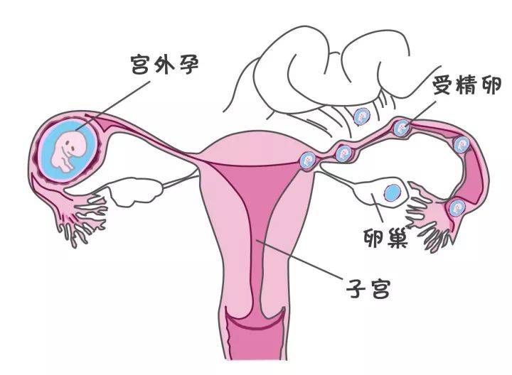 宫外孕照片初期图片