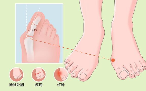牛江红,穿高跟鞋会导致拇外翻吗?_脚趾_趾骨_因素