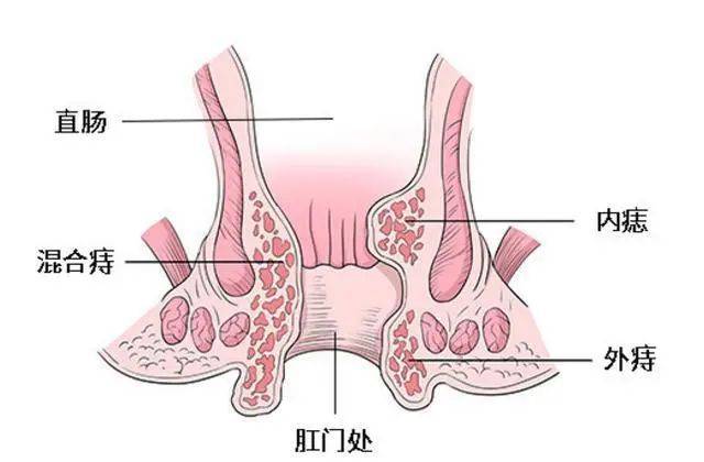 痔疮是怎样形成的图片