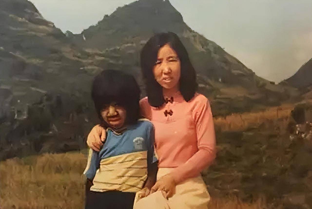 原创当年轰动一时的毛孩42岁娶90后娇妻生下一子未遗传长毛