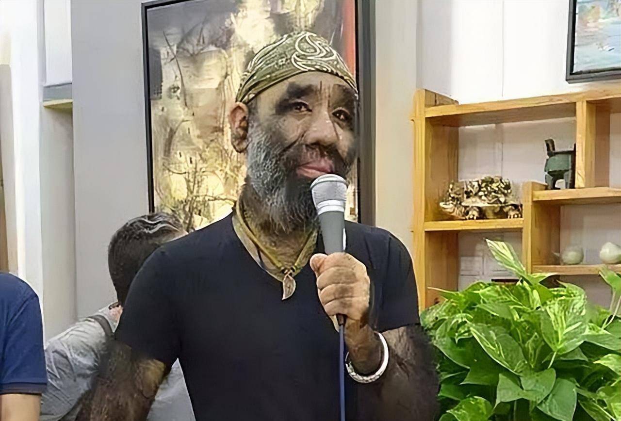 原创当年轰动一时的毛孩42岁娶90后娇妻生下一子未遗传长毛