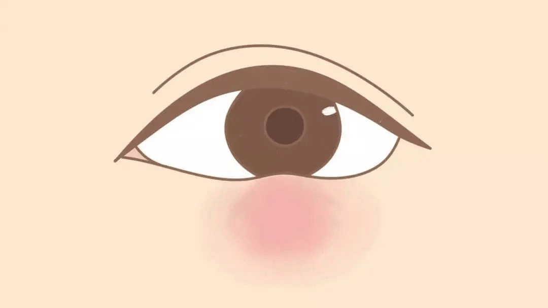 又双叒叕长了麦粒肿眼科大夫教你一次搞定