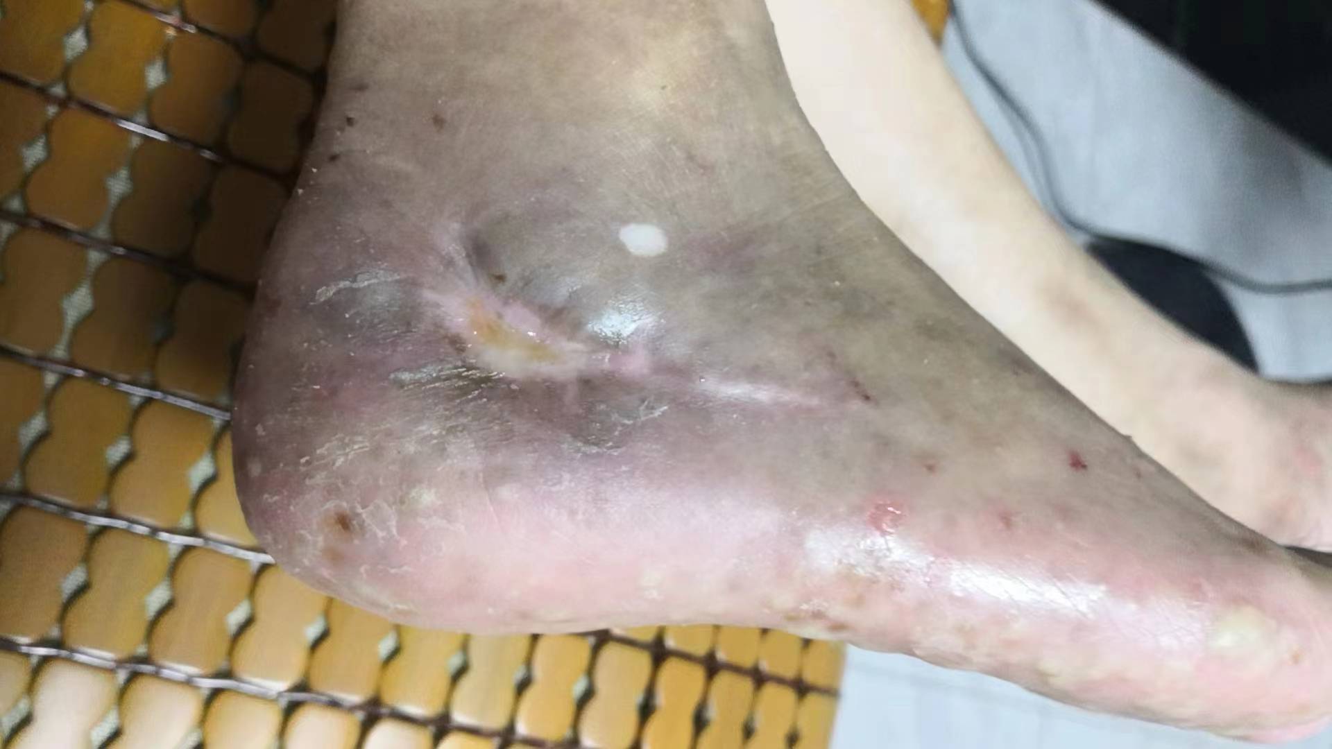 只要我们保持创口在缩小,肉芽生长健康的大方向,同时结合中西医的治疗