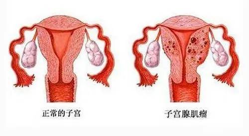 3个症状帮你辨别1,白带增多如果是生长在子宫壁上的肌瘤,会导致子宫腔
