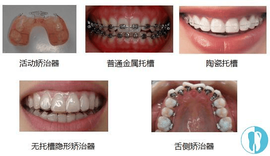 成人矫正牙齿适合哪种矫治器