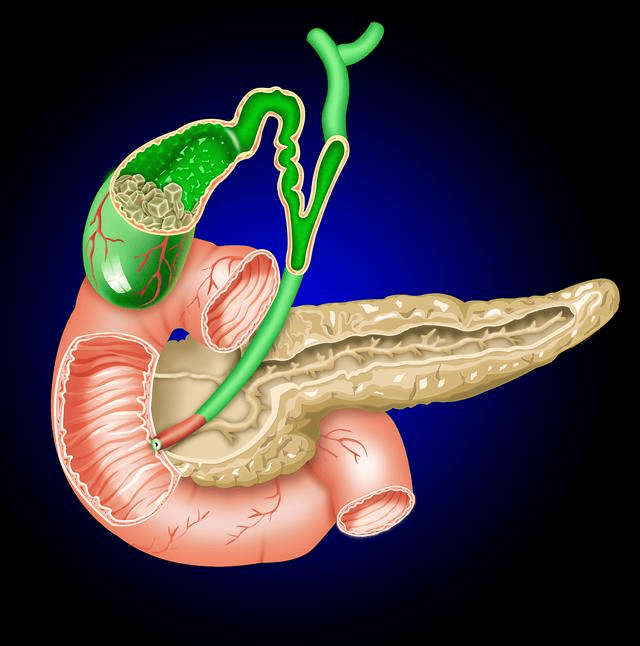 人没了胆囊,身体会有啥变化呢?3种疾病或会找上门,能不切别切