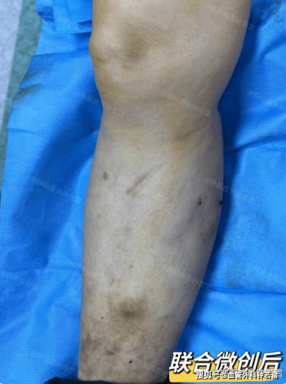 湖北70岁阿姨静脉曲张,担心高血压不敢手术,直到了解联合微创_局部_皮
