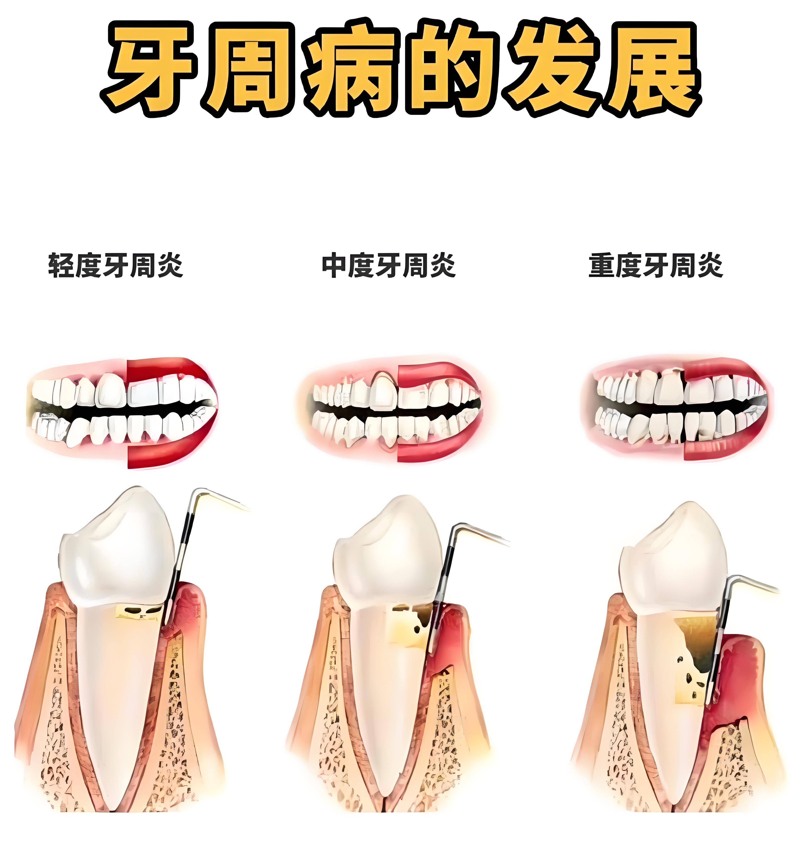 中度牙周炎图片图片