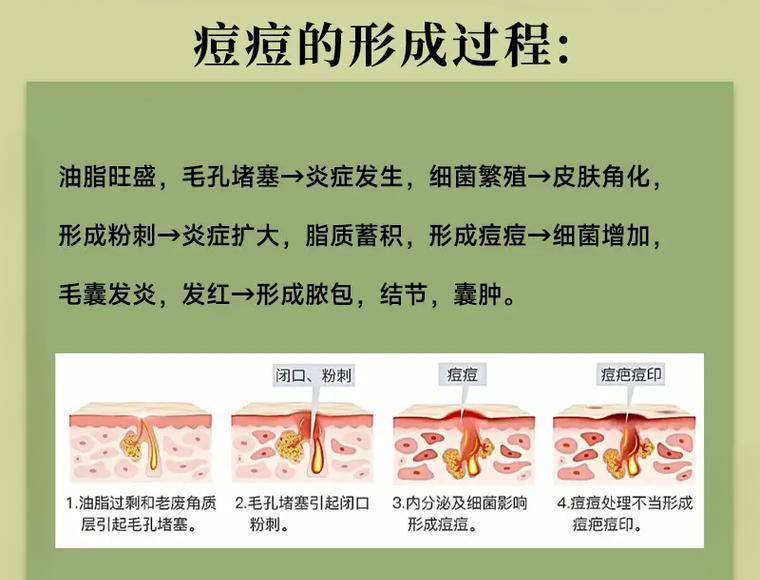 额头脸颊长痘教您正确快速消除