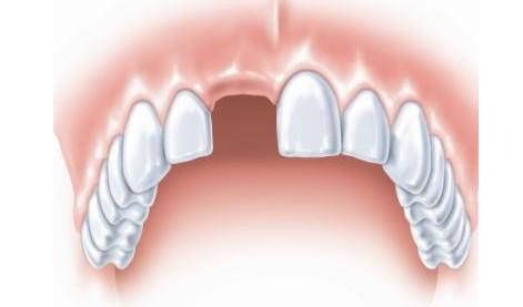 牙齿掉了可以立即种牙吗