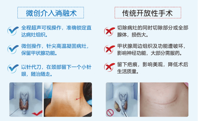 甲状腺结节新篇章 朝阳门中西医结合微创消融