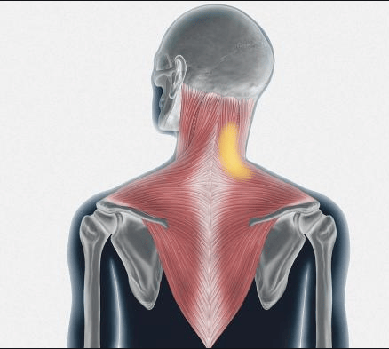 痉挛性斜颈:揭秘颈部肌肉的"不自主舞蹈"