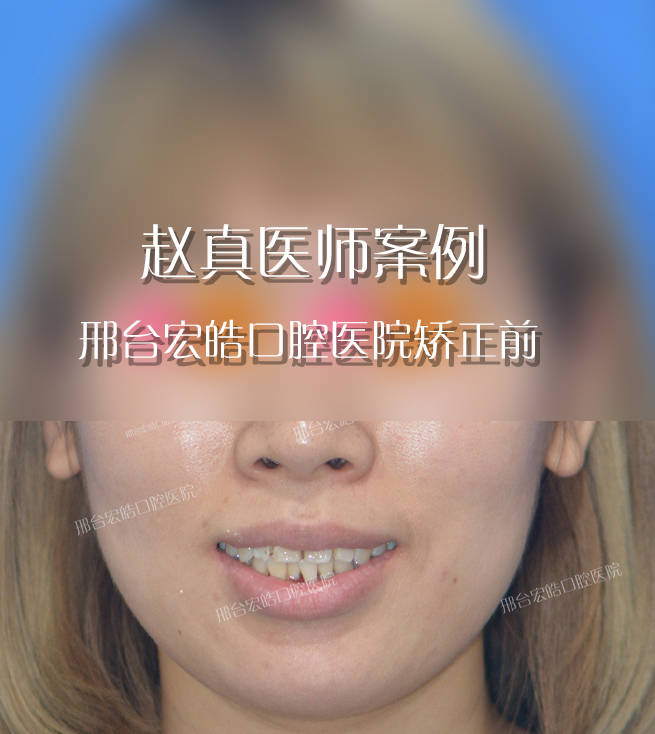邢台29岁女孩矫正牙齿20个月，效果堪比整容-小女孩矫正牙齿