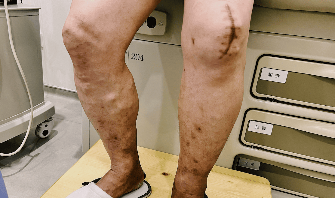 腿上静脉曲张几十年,一对夫妻来沪求医过程感动医生