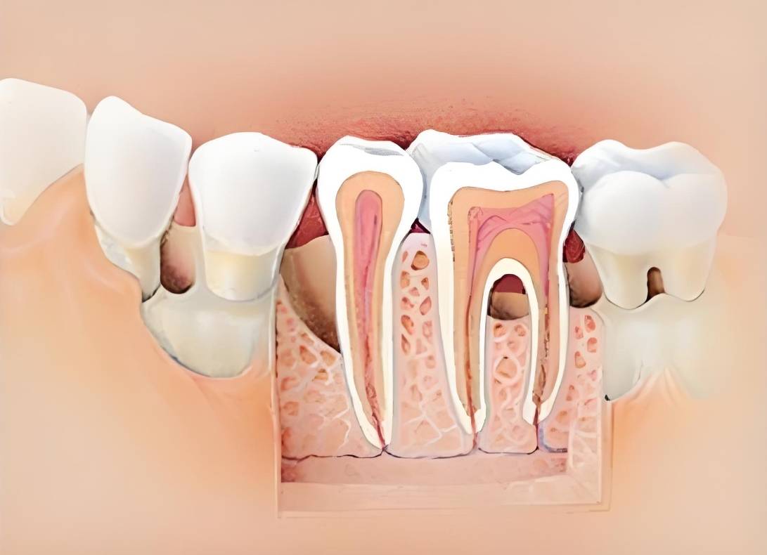 牙根并进行相应的治疗,如根管治疗,打桩等,以恢复牙齿的形态和功能