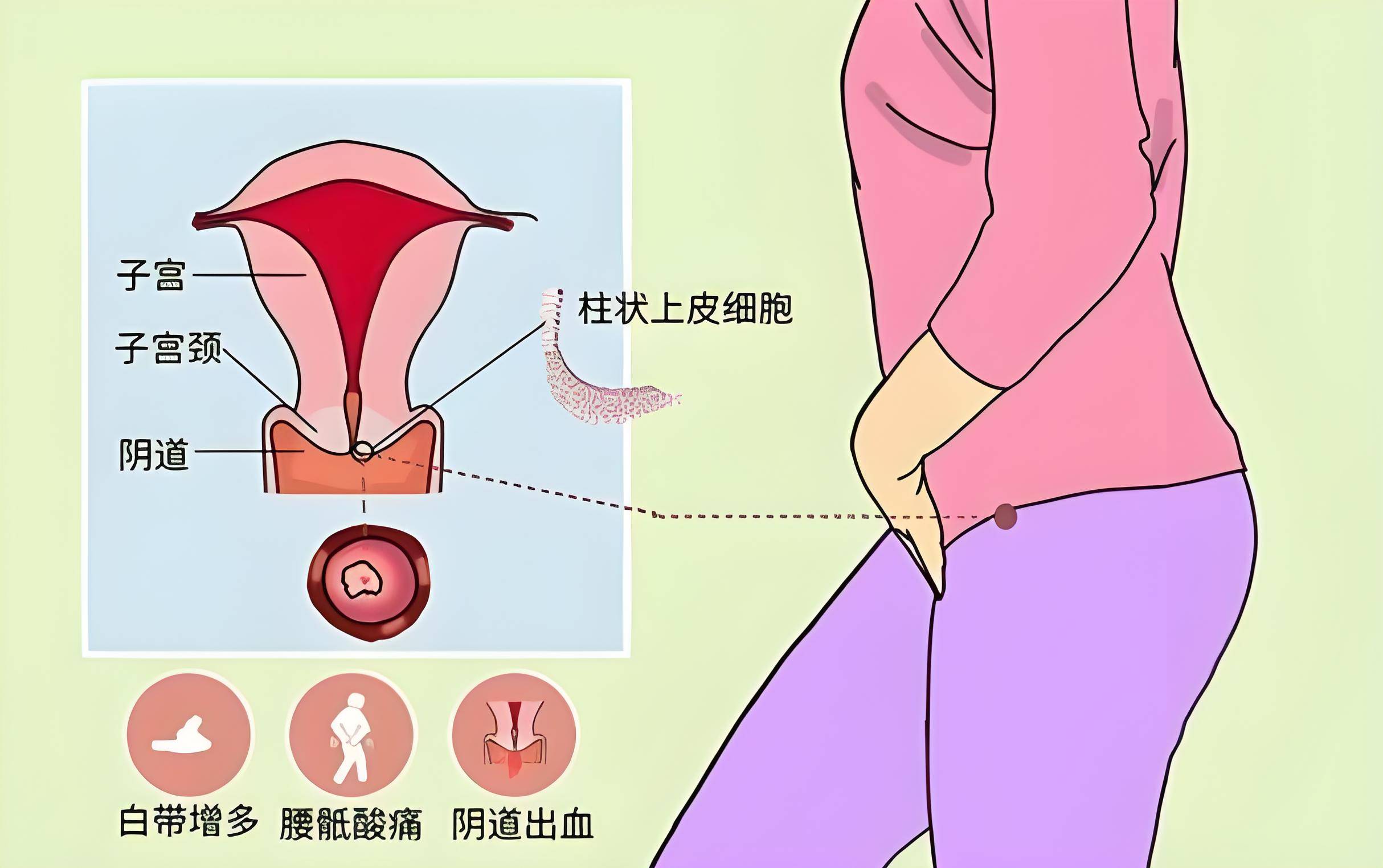 急性宫颈炎和慢性宫颈炎症状有什么不一样