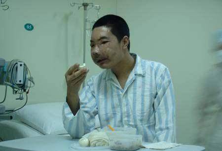 医学史上的传奇:中国换脸第一人,变不可能为可能_李国兴_郭树忠_手术