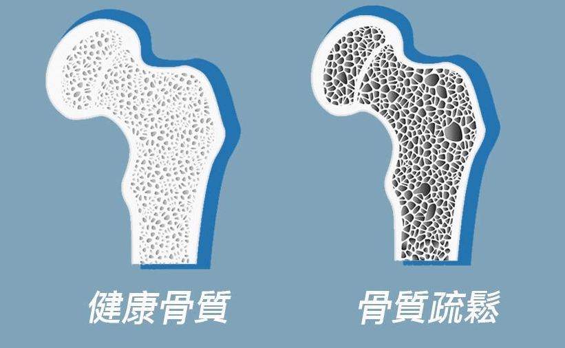 所有的骨质疏松或是蓄谋已久