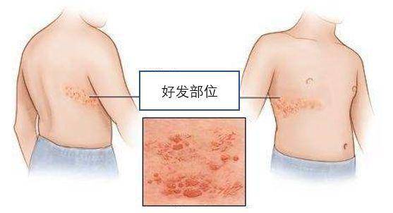 带状疱疹一般几天能好?"腰缠火丹"能治愈吗?