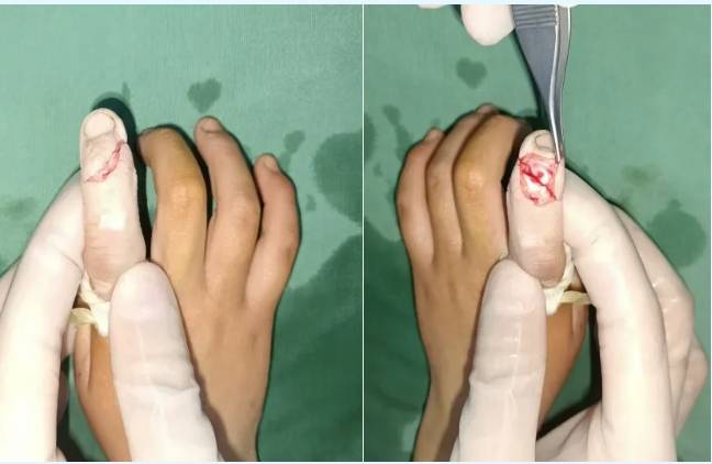 爸爸切菜误伤5岁女儿手指,紧急手术修复骨骺损伤