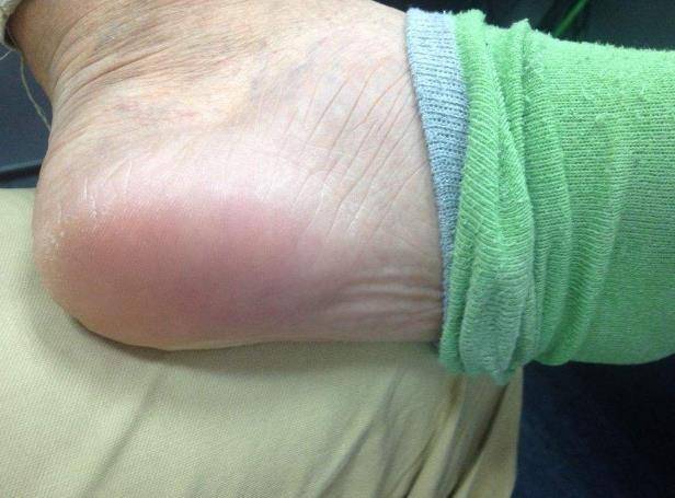 脚后跟老是疼,是怎么回事?可能预示着这4种疾病,别忽视!