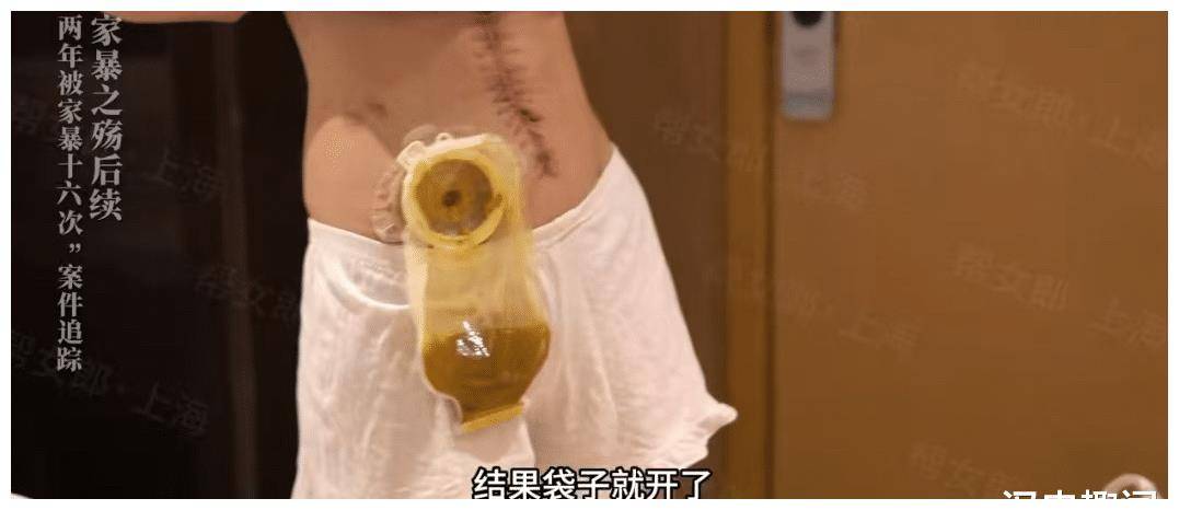 2年被家暴16次,终身需挂粪袋的女子喜极而泣,她终于可以离婚了