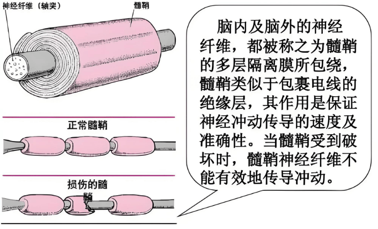 揭秘脱髓鞘病变:那些不容忽视的神经系统警示信号