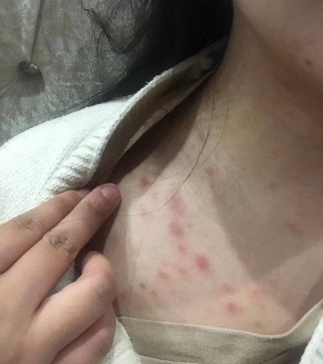 用三个小技巧轻松摆脱皮肤疹子不再长的秘密!