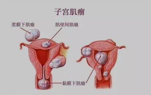 子宫肌瘤有哪三种类型(哪些子宫肌瘤需要进行手术)