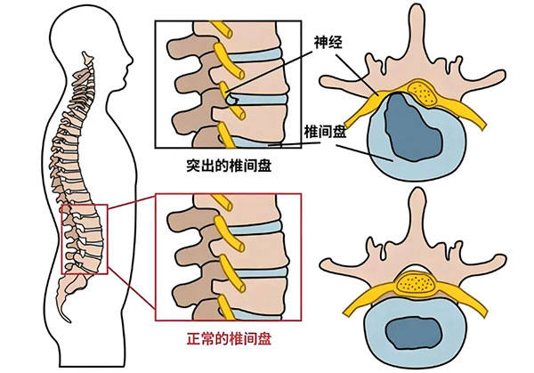 腰椎间盘位置结构图图片