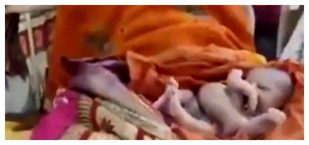 印度一孕妇诞下"怪婴",拥有4只手和4条腿,民众当神明膜拜