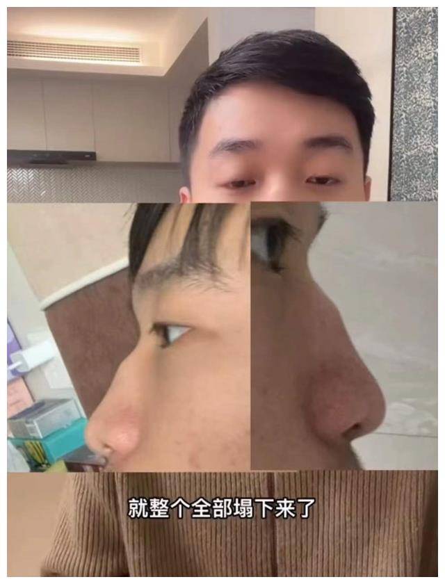 男网红咽喉不适去医院检查,毫不知情被"整容",鼻子坍塌惨毁容